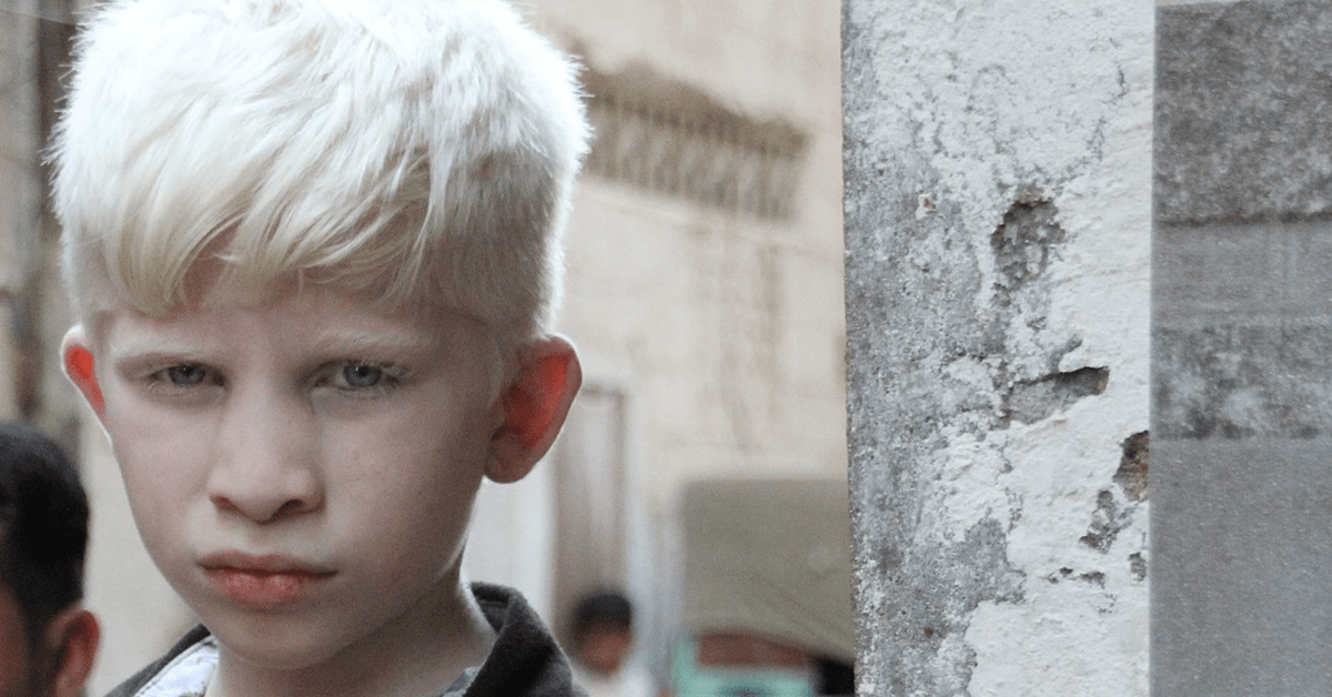 Totul despre albinism