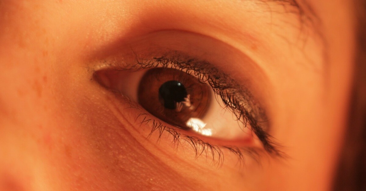 Woman's eye with amblyopia