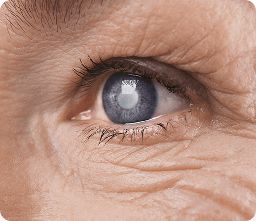 Eyes with a cataract